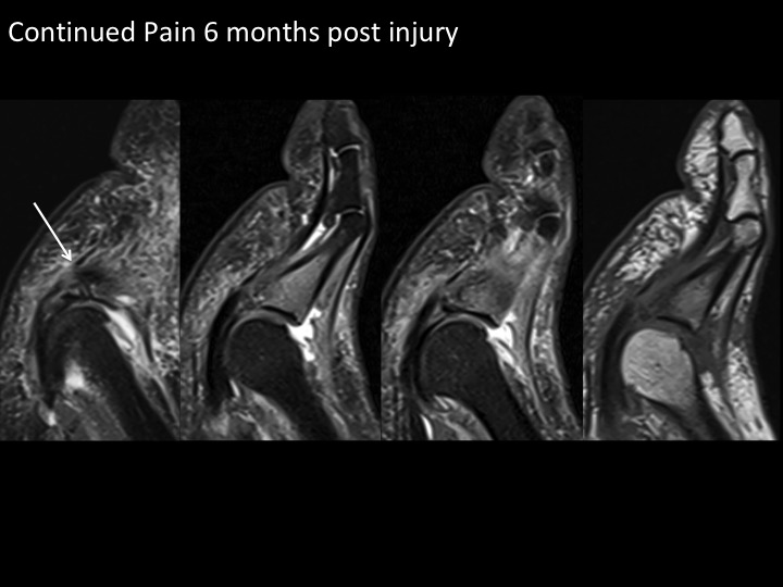 Figure 1 for case plantar plate of metatarsophalangeal joint ( RID3134 )